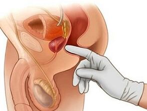 Masaxe de próstata para tratar a prostatite nos homes