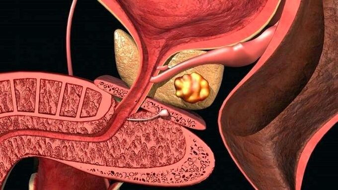 Depósitos de pedra na próstata na prostatite calcificada