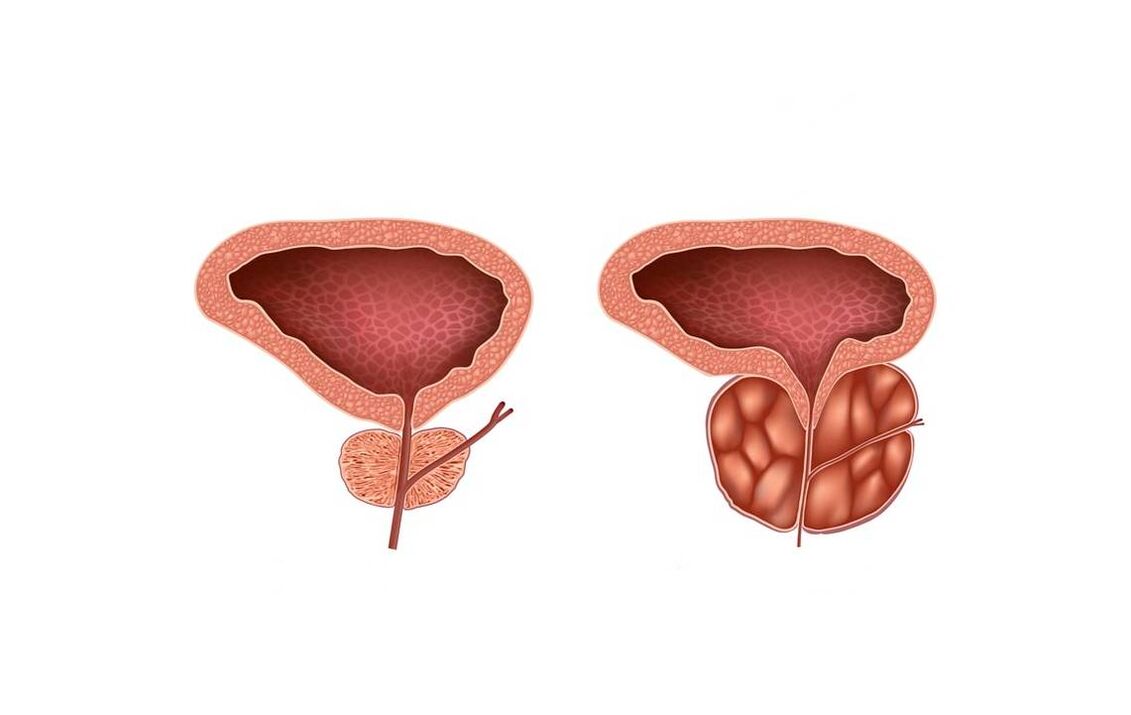 Síntomas de prostatite en homes