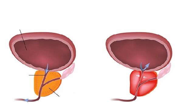 próstata normal e inflamada