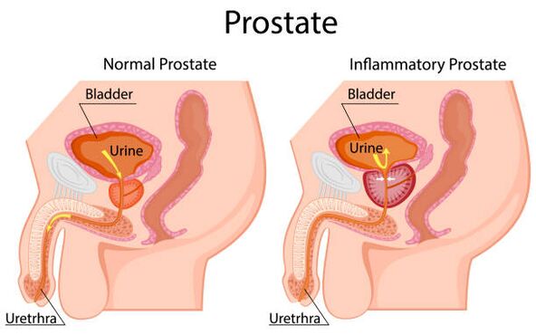 próstata sa e inflamada