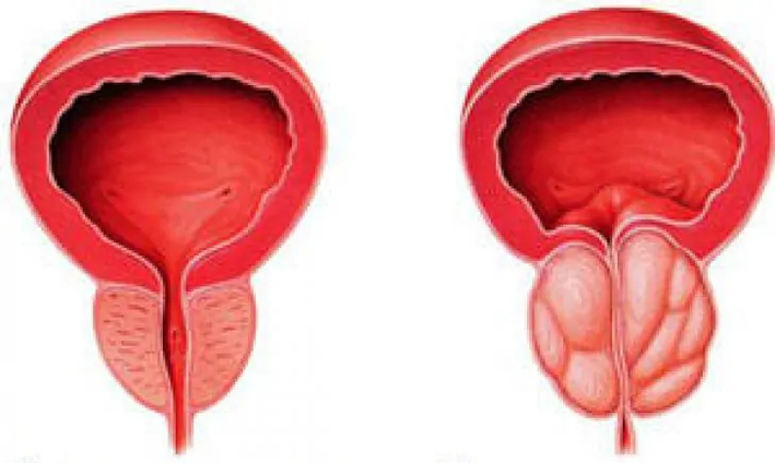 Próstata normal (esquerda) e prostatite crónica inflamada (dereita)