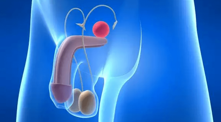 A prostatite é unha inflamación da próstata nos homes que require un tratamento complexo